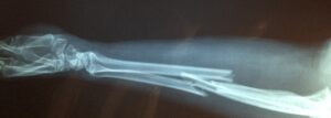 złamana ręka - pomóc może fizjoterapia - Fizjoterapia PANACEUM Kraków