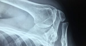 uszkodzony bark - Fizjoterapia PANACEUM Kraków
